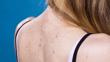 Nguyên nhân gây mụn lưng ở nữ giới và cách khắc phục