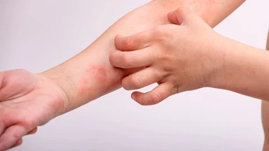 Nguyên nhân viêm da cơ địa người lớn là gì? Cách điều trị