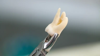 Nhổ răng có đau không và cách giảm đau hiệu quả sau khi nhổ?
