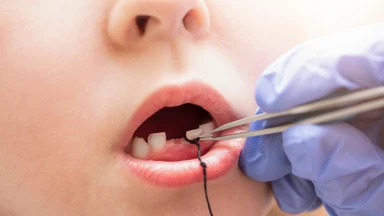 Nhổ răng sữa bằng chỉ: Nên hay không theo lời khuyên bác sĩ?