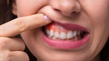 Nổi cục cứng ở lợi là gì? Nguyên nhân, dấu hiệu và cách chăm sóc răng lợi đúng cách