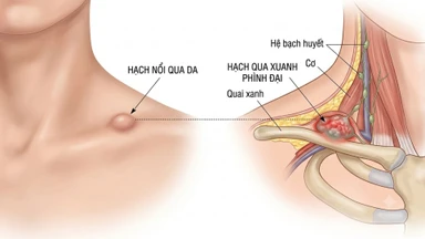 Nổi hạch ở xương quai xanh là dấu hiệu gì? Nguyên nhân và khi nào cần đi khám