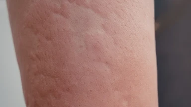 Nổi mề đay cấp tính: Nguyên nhân, mức độ nguy hiểm và cách xử trí