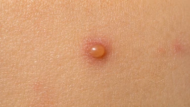 Nổi mụn nước không ngứa là gì? Nguyên nhân và cách xử trí an toàn