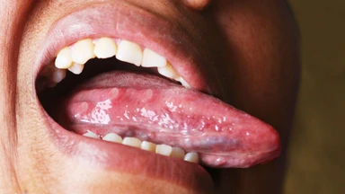 Nổi mụn ở lưỡi đau rát: Nguyên nhân, bệnh lý liên quan và cách xử lý tại nhà
