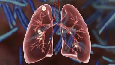 Nốt phổi: Nguyên nhân, chẩn đoán và hướng điều trị hiệu quả