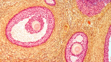 PCOS với u nang buồng trứng: Điểm khác biệt quan trọng ảnh hưởng sinh sản