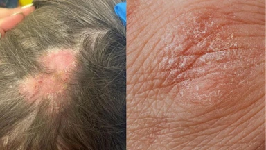Phân biệt nấm da đầu và viêm da tiết bã qua các triệu chứng thường gặp