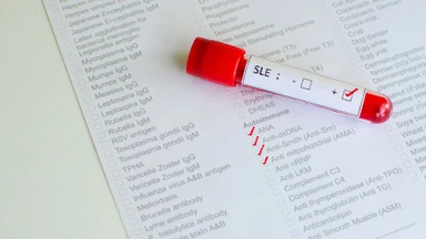 Tiêu chuẩn chẩn đoán lupus ban đỏ hệ thống hiện nay