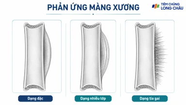 Phản ứng màng xương: Nguyên nhân, dấu hiệu và ý nghĩa chẩn đoán