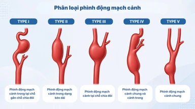 Phình động mạch cảnh: Nguyên nhân, dấu hiệu và phương pháp điều trị