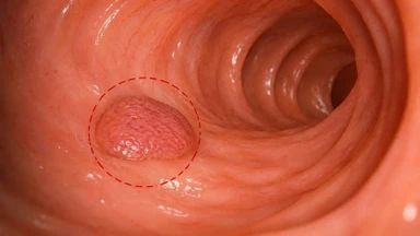 Polyp đại tràng không cuống là gì? Có nguy hiểm không?