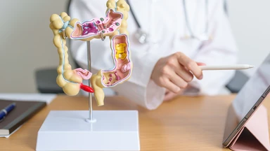 Polyp đại trực tràng ở trẻ em: Dấu hiệu, nguyên nhân