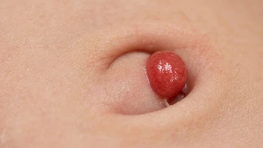 polyp_ron_o_tre_so_sinh_dau_hieu_chan_doan_va_dieu_tri_2_1d3f1c6dac