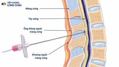 Quá trình gây tê ngoài màng cứng khi chuyển dạ diễn ra thế nào?