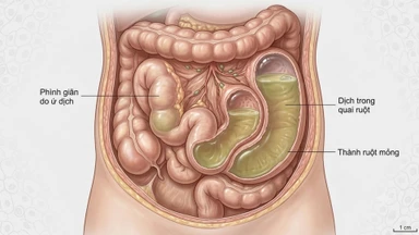 Quai ruột ứ dịch có nguy hiểm không? Nguyên nhân, dấu hiệu và cách điều trị