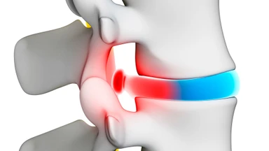 Rách vòng xơ đĩa đệm có lành được không? Hướng điều trị hiệu quả và phòng ngừa
