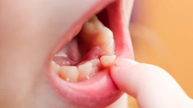 Răng sữa thay bao nhiêu cái và những điều ba mẹ cần biết
