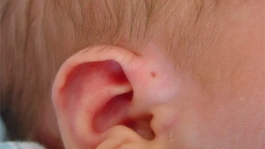 Rò luân nhĩ là gì? Nguyên nhân, dấu hiệu và cách điều trị hiệu quả