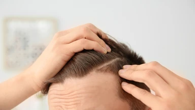 Rối loạn nội tiết tố nam gây rụng tóc là gì? Những điều cần biết