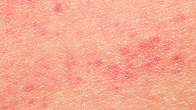 Sarcoma Kaposi là gì? Dấu hiệu nhận biết, đối tượng nguy cơ và hướng điều trị hiện nay