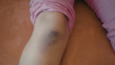 Sarcoma mạch máu: Dấu hiệu nhận biết, nguyên nhân và cách phát hiện sớm 