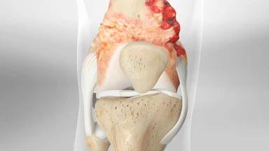 Sarcoma sụn là gì? Nguyên nhân, triệu chứng và cách điều trị