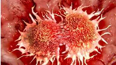 Sarcoma tử cung là gì? Dấu hiệu nhận biết, nguyên nhân và phương pháp điều trị hiện nay