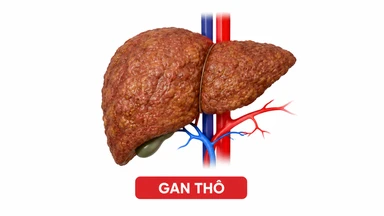 Siêu âm gan thô nhẹ: Dấu hiệu cảnh báo sớm về sức khỏe gan