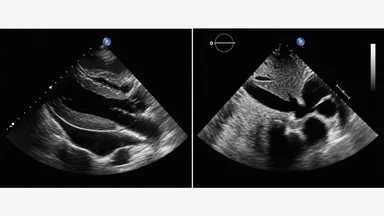 Siêu âm phổi POCUS: Công cụ chẩn đoán bệnh phổi nhanh và chính xác