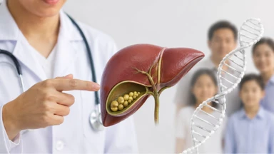Sỏi mật có di truyền không? Những yếu tố làm tăng nguy cơ mắc sỏi mật