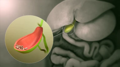 Sỏi túi mật 10mm có nguy hiểm không? Các trường hợp cần phẫu thuật