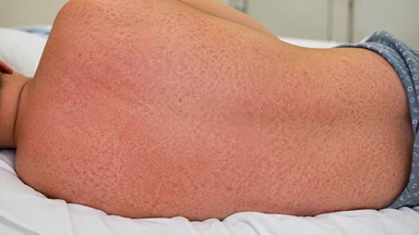 Rối loạn đông máu trong sốt xuất huyết dengue: Biến chứng nguy hiểm cần cảnh giác