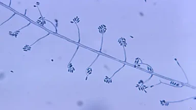 sporothrix_schenckii_la_gi_va_cach_nhan_biet_benh_nam_da_0_b284a553ef