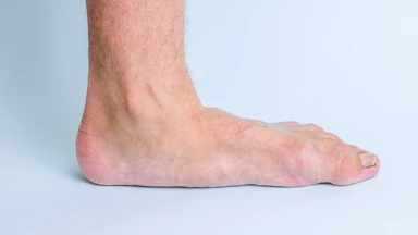Tác hại của bàn chân bẹt: Biến chứng và cách khắc phục hiệu quả