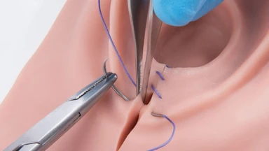 Tại sao vết khâu tầng sinh môn bị sưng? Nên làm gì khi gặp phải tình trạng này?