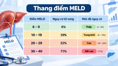 thang_diem_meld_y_nghia_va_cach_danh_gia_benh_gan_giai_doan_cuoi_1_d273cb89d0