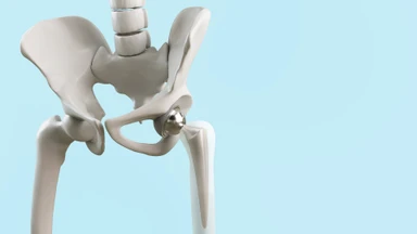 Thay khớp háng là gì? Các yếu tố rủi ro, biến chứng có thể gặp phải