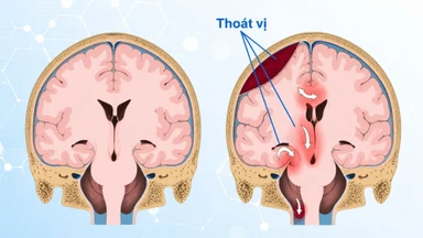 Thoát vị não là gì? Nguyên nhân, dấu hiệu và cách điều trị