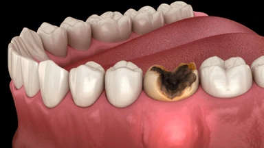 Răng chết tủy: Triệu chứng và phương pháp khắc phục