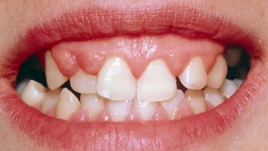 Tìm hiểu viêm nướu triển dưỡng: Dấu hiệu nhận biết và phương pháp phòng ngừa