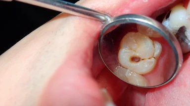 Trám răng rồi có bị sâu lại không? Nguyên nhân và cách phòng ngừa