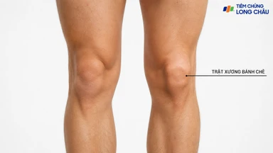 Trật xương bánh chè: Nguyên nhân, dấu hiệu và cách điều trị hiệu quả