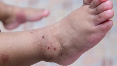 Trẻ bị tay chân miệng có cần uống Oresol? Giải đáp chi tiết cho cha mẹ