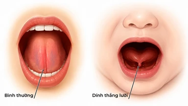 Trẻ cắt thắng lưỡi có bị sốt không?