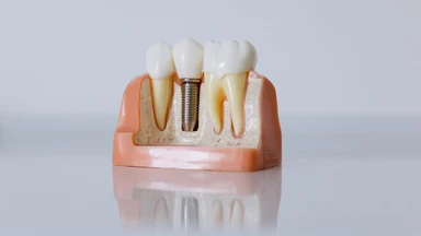 Trồng răng sứ giá bao nhiêu 1 chiếc? Trồng răng sứ có đau không?