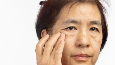 Trũng má và malar mound là gì? Nguyên nhân và cách cải thiện