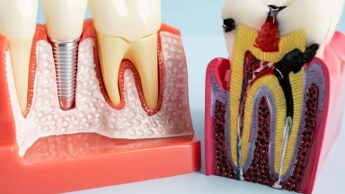 Tuổi thọ răng lấy tủy là bao lâu? Các yếu tố ảnh hưởng đến tuổi thọ răng sau lấy tủy
