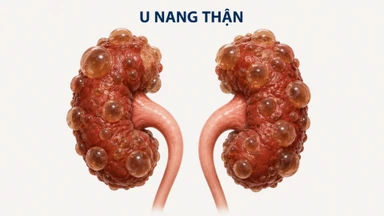 U nang thận có nguy hiểm không? Dấu hiệu, nguyên nhân và cách điều trị