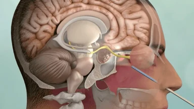 U nguyên bào thần kinh khứu giác: Nguyên nhân, triệu chứng và điều trị
